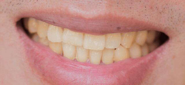 Żółte zęby – jak poradzić sobie z tym problemem?
